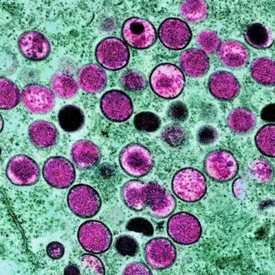 Is monkeypox a deadly virus?